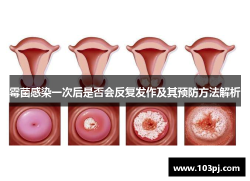 霉菌感染一次后是否会反复发作及其预防方法解析